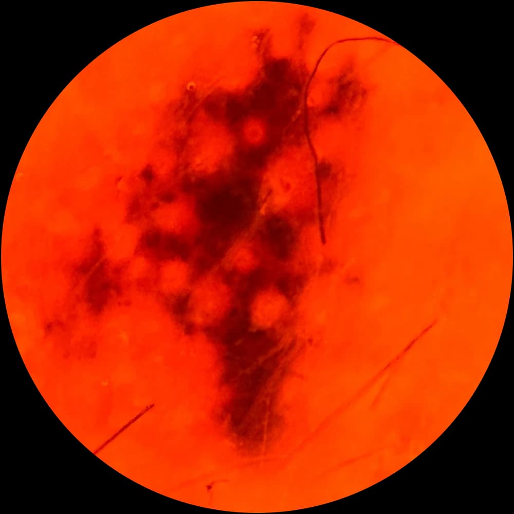 Amber 600 nm dermoscopic view