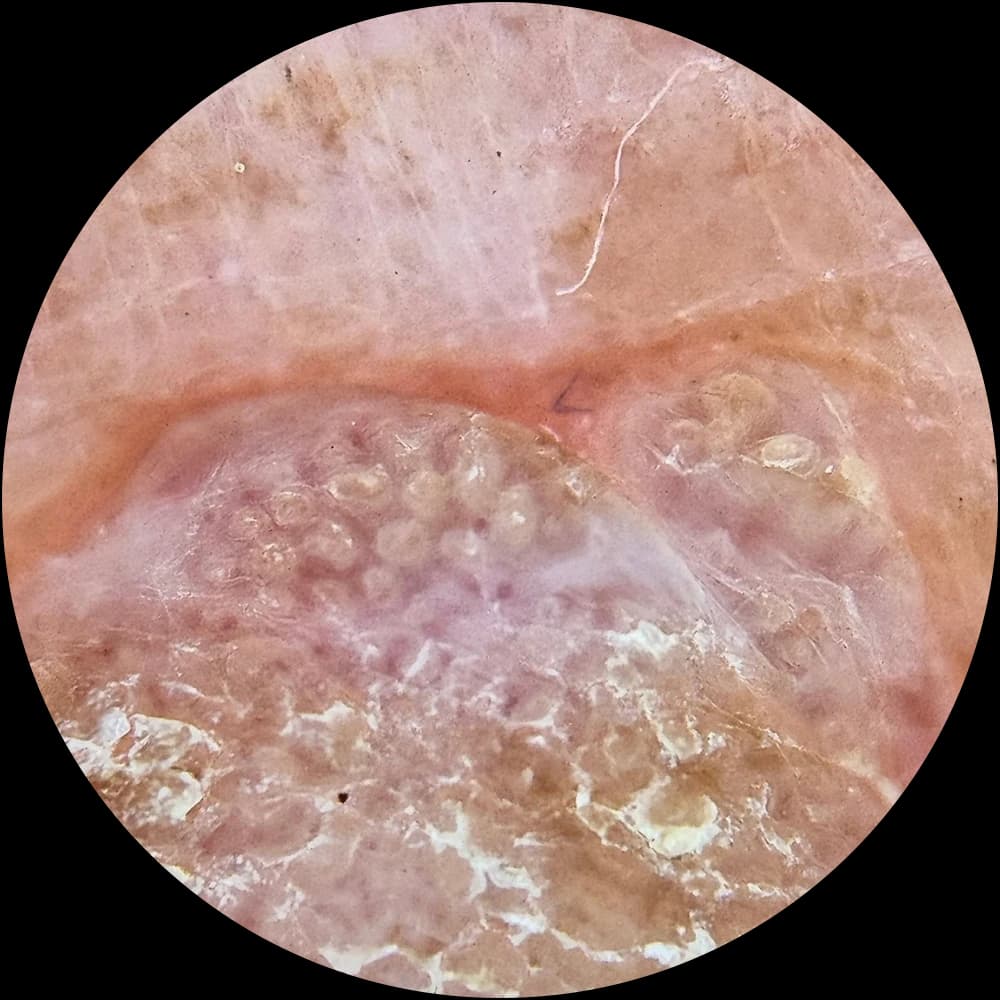 Non-polarised dermoscopic view