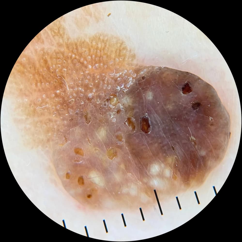 Cross-polarised dermoscopic view