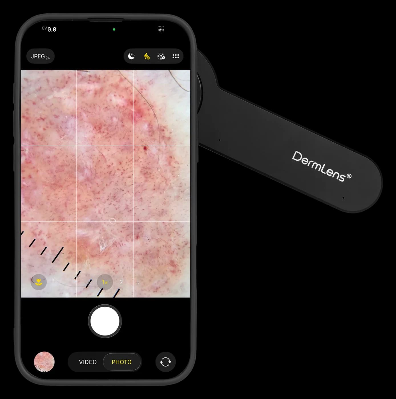 Smartphone screen showing a live dermoscopic view through the DermLens M6
